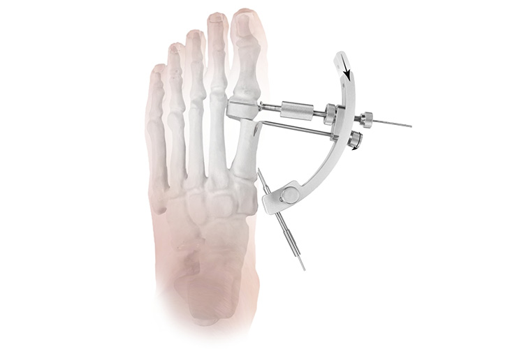 Outils de guidage pour la correction de l'hallux valgus
