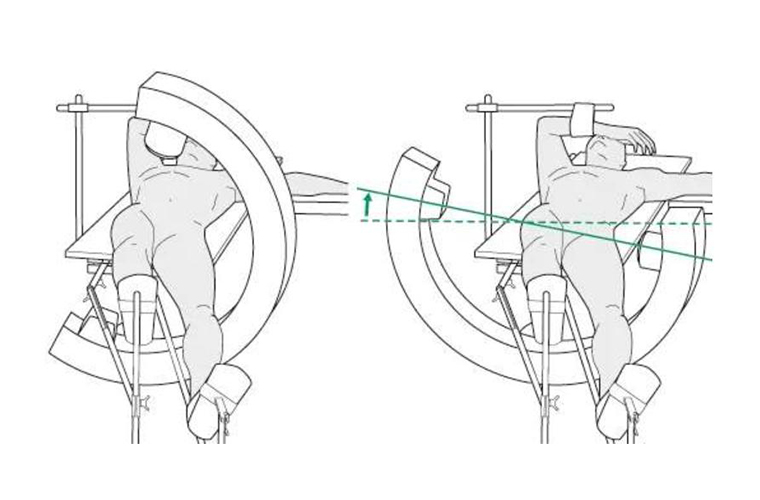 大腿骨髄質釘付け：重要な外科原理 