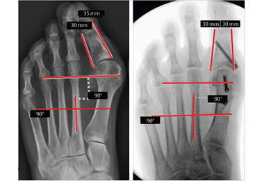 Chirurgie mini-invasive de l'hallux valgus
